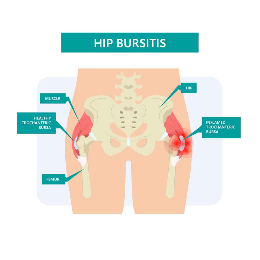 Hip Bursitis Diagram Liz Tough Clinic