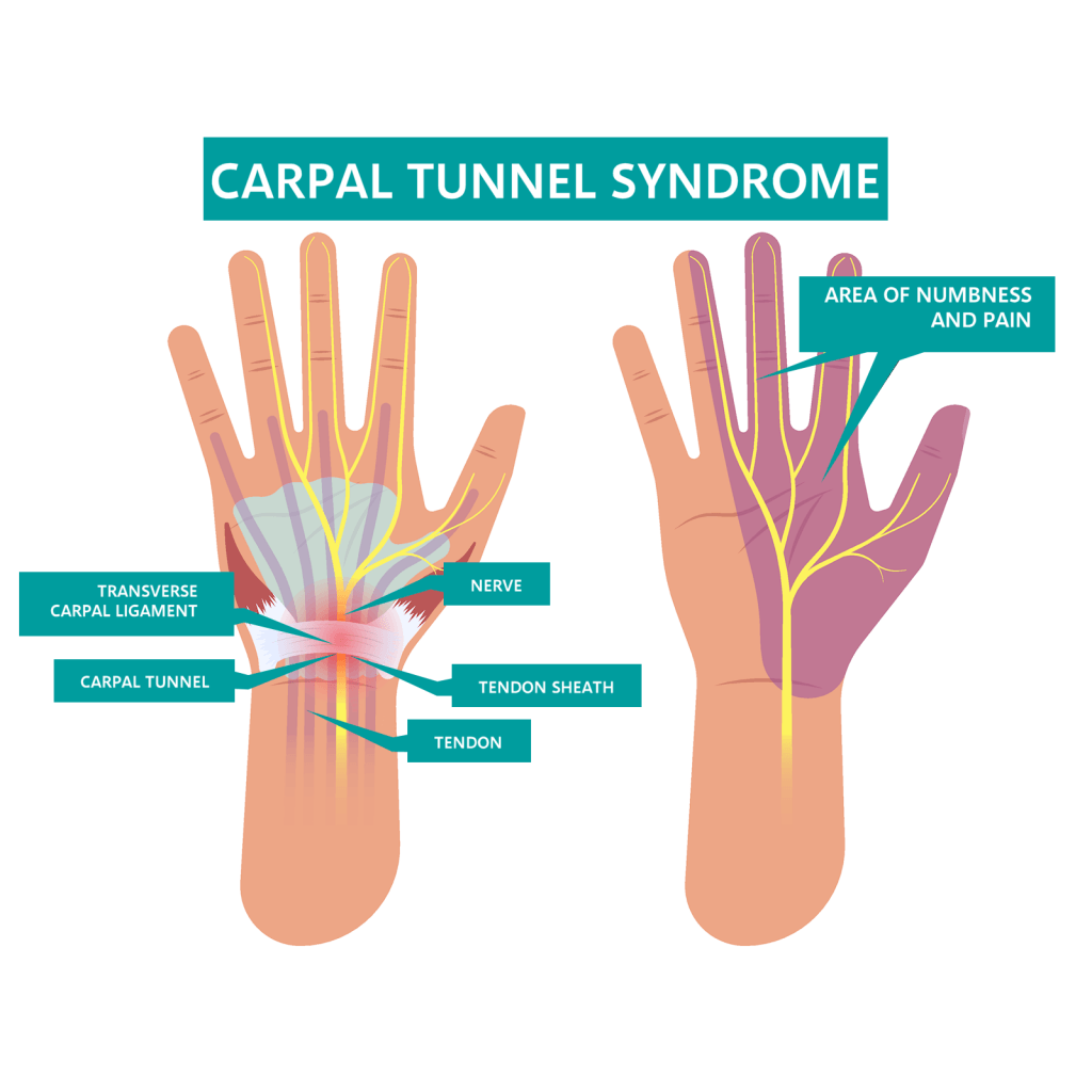 Carpel Tunnel Syndrome • Liz Tough Clinic