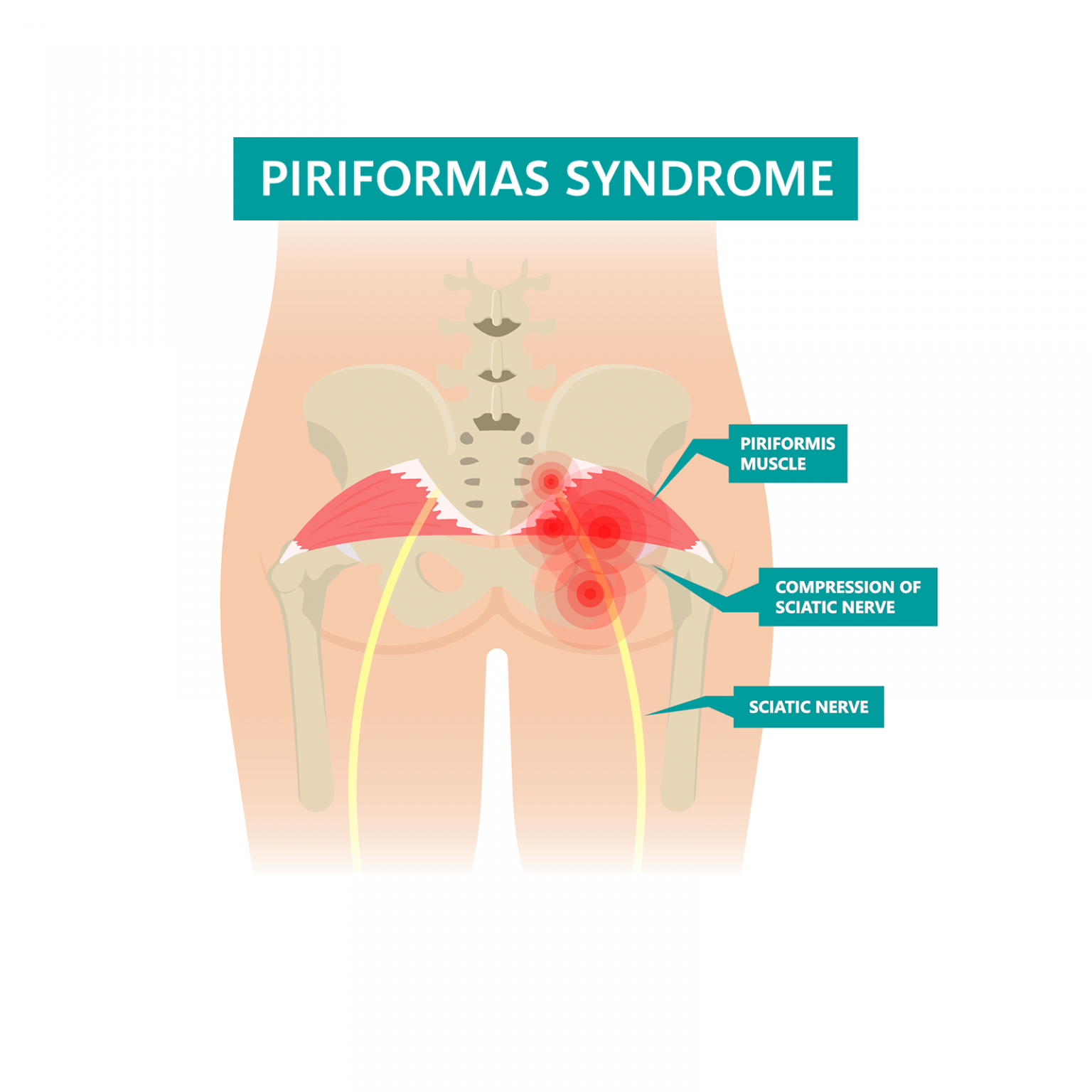 piriformis syndrome