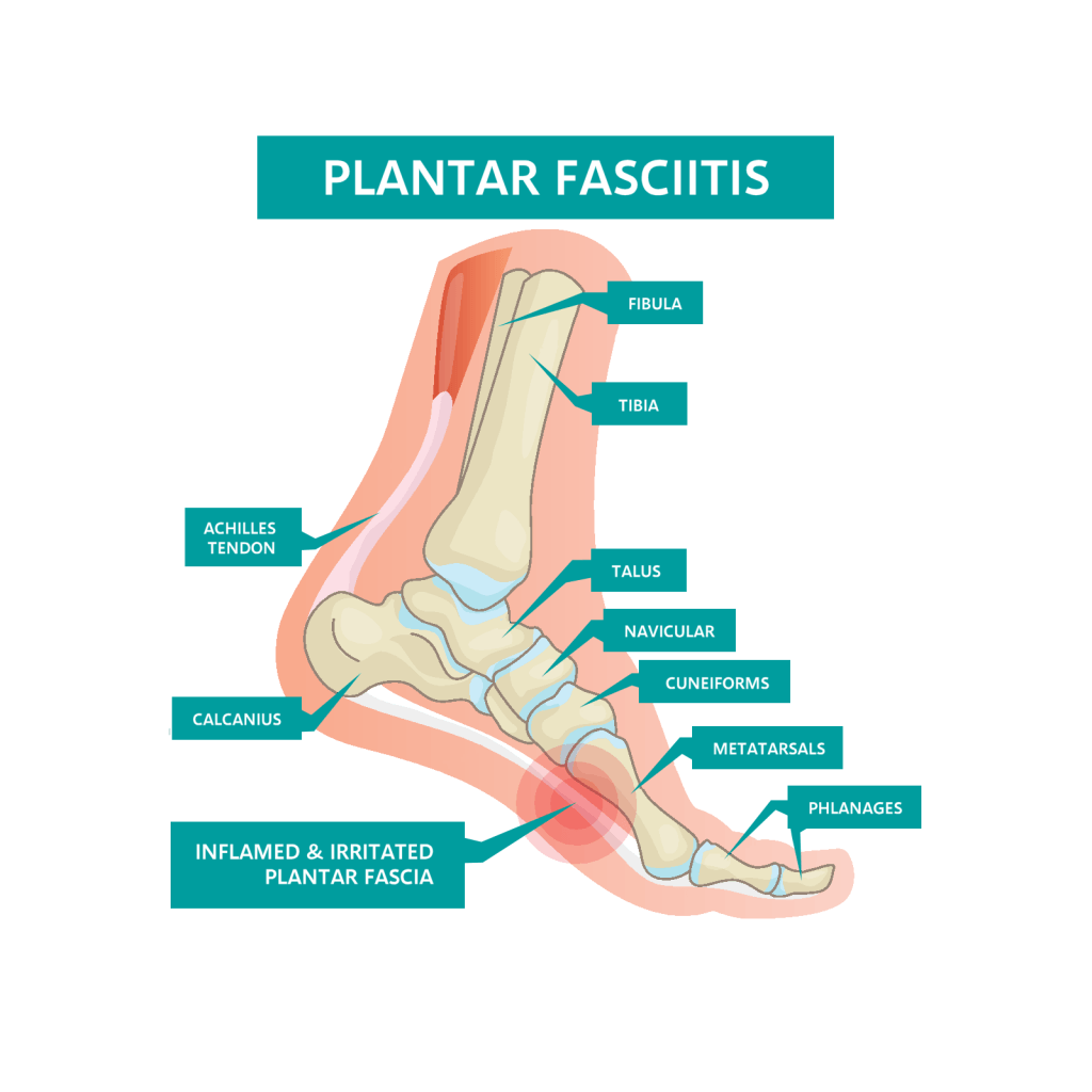 Plantar Fasciitis Diagram Liz Tough Clinic