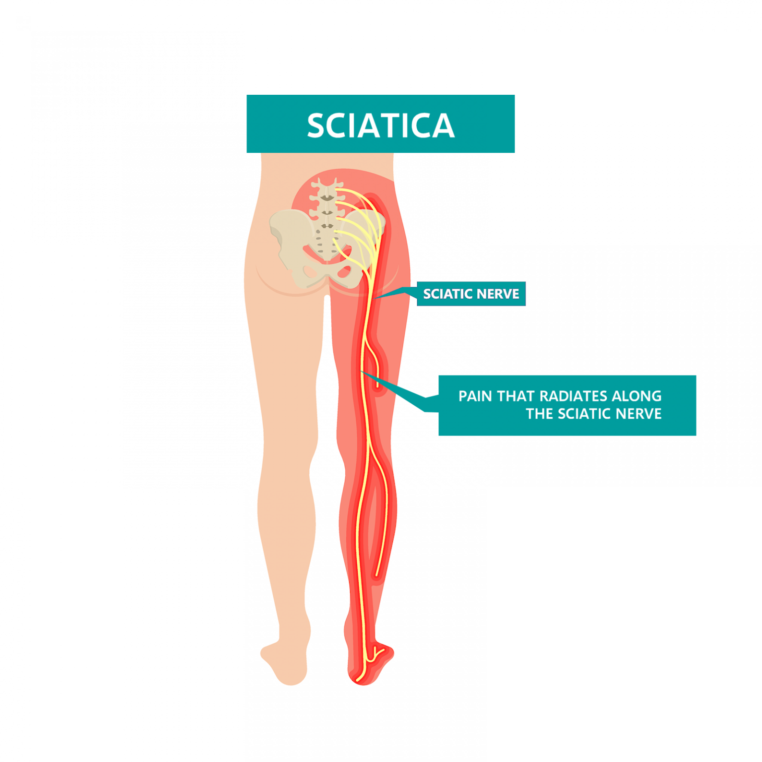 sciatica-liz-tough-clinic