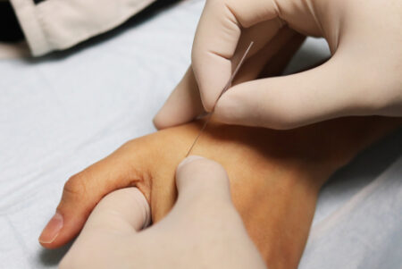 Dry Needling Dry needling for carpal tunnel syndrome