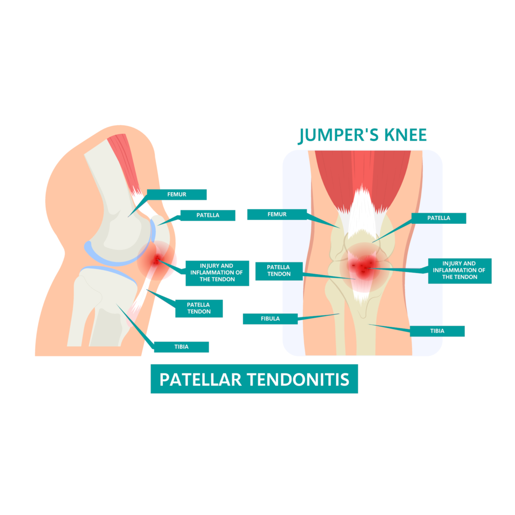 patellar tendonitis patellar tendonitis