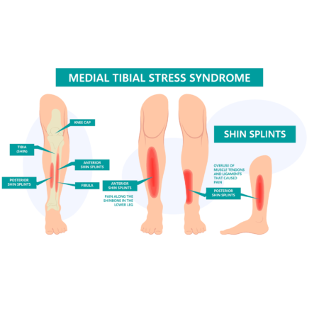 shin splints medial tibial stress syndrome